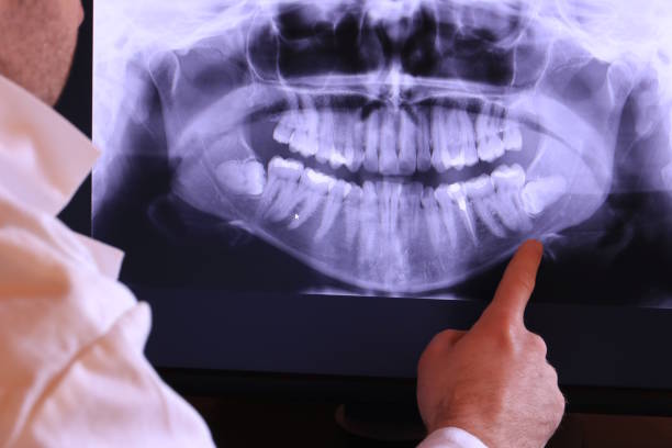 Best Emergency Tooth Extraction in Barry, IL