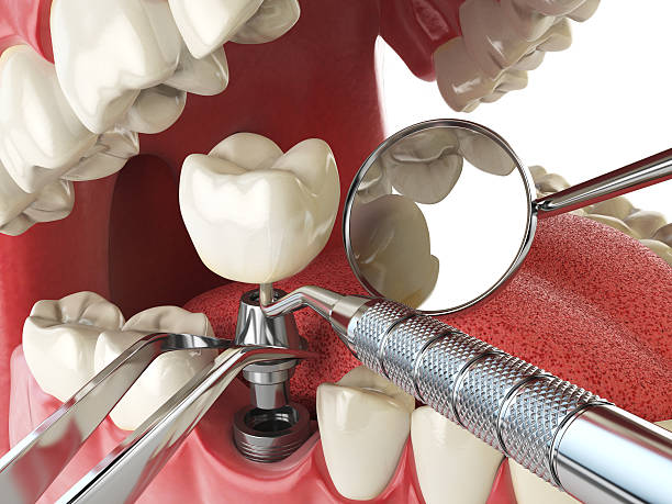 Best Emergency Treatment for Dental Infections or Abscesses in Barry, IL